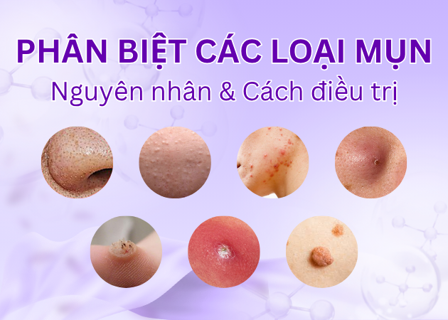 Các loại mụn trên mặt: Phân biệt, nguyên nhân & cách điều trị