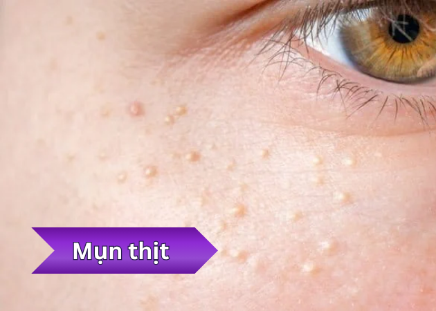 Mụn thịt