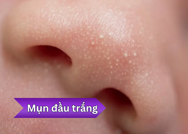 Mụn đầu trắng