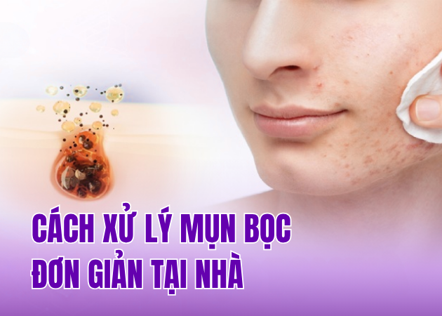 10 cách xử lý mụn đơn giản dễ thực hiện tại nhà