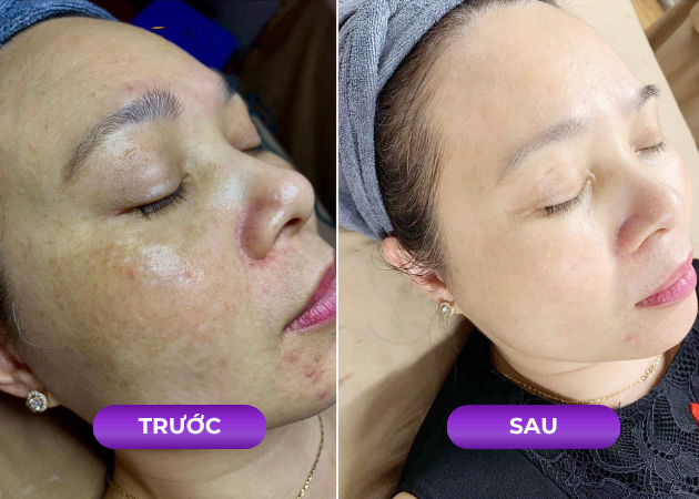 Thay đổi ngoại mục sau khi điều trị nám tại Cerabe Spa
